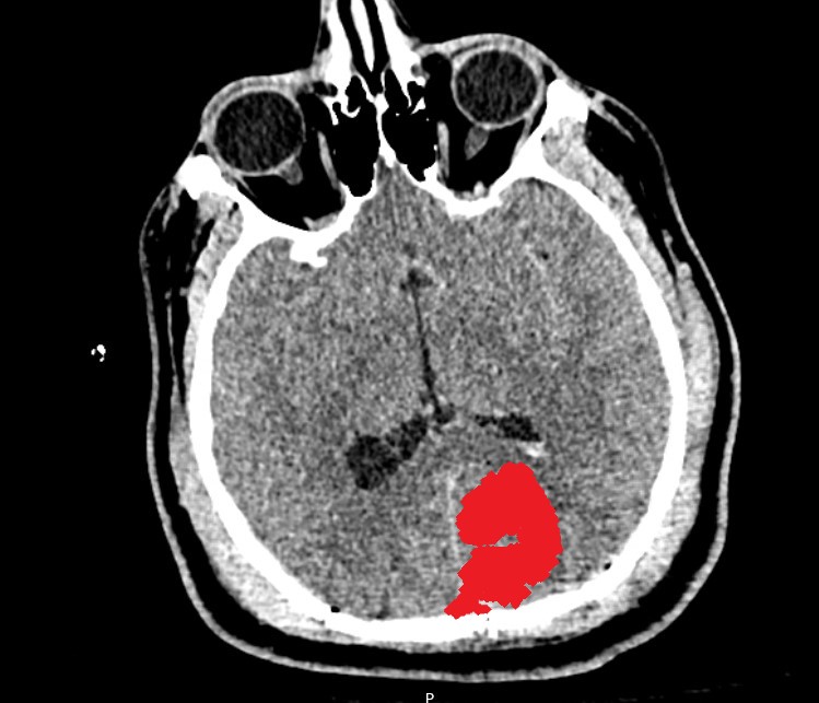 Intraparenchymal Hemorrhage