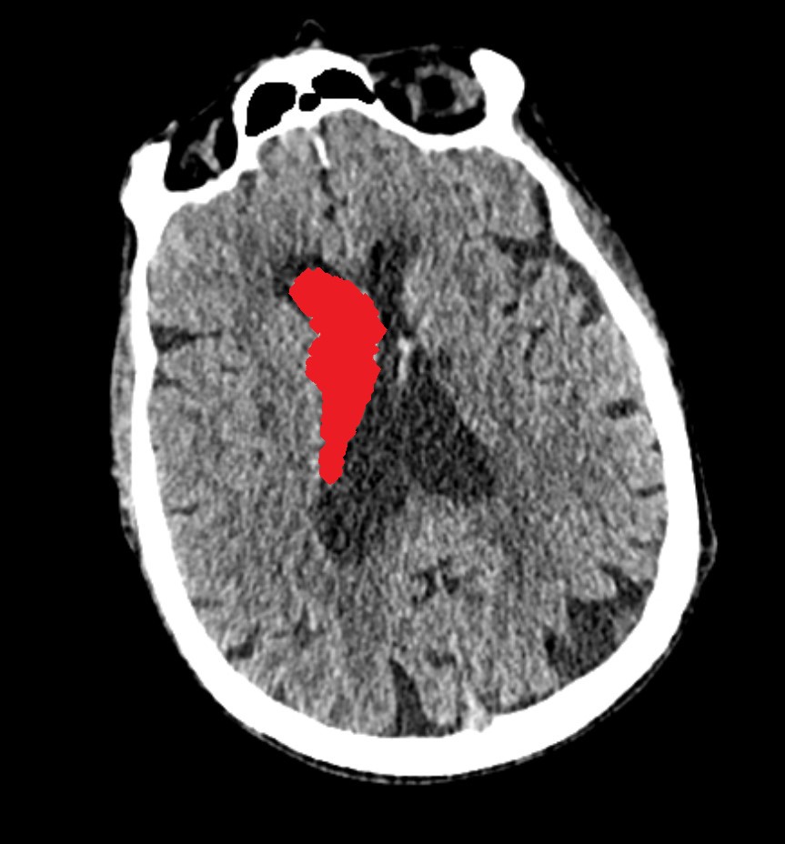 Intraventricular Hemorrhage