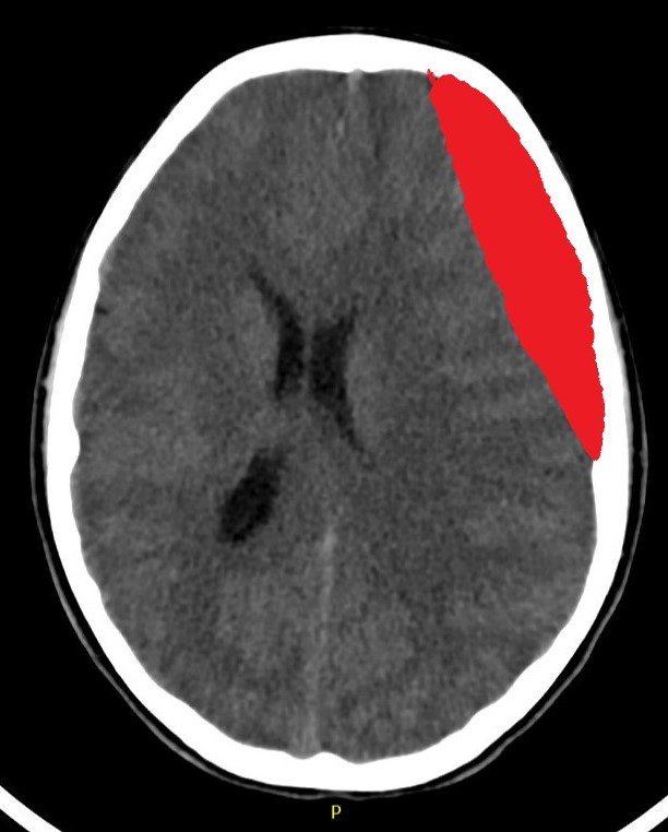 Subdural Hematoma Bleed
