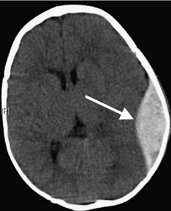 Epidural Hemorrhage