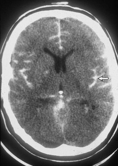 Subarachnoid Hemo